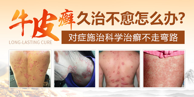 南京华肤贾军:银屑病冬病夏治的秘密